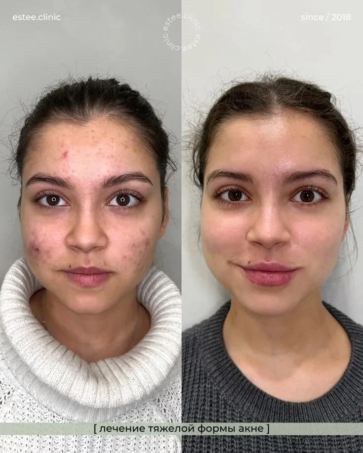 Clear Skin After CO2 Laser