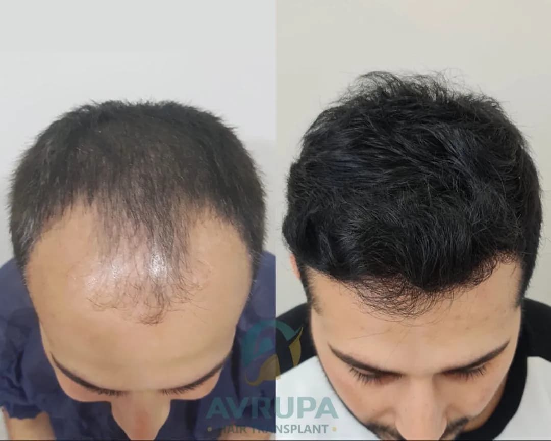 Dense Hairline After Hair Transplant