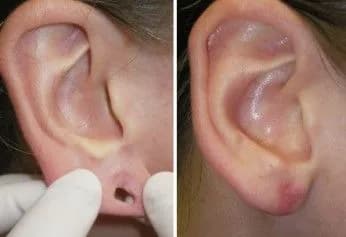 Repaired Ear Lobe After Surgery