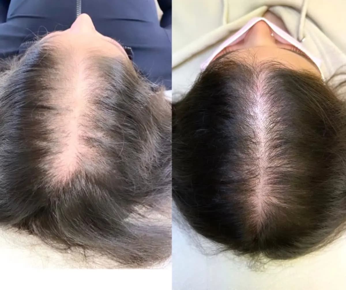 Thick Hair After PRP Treatment
